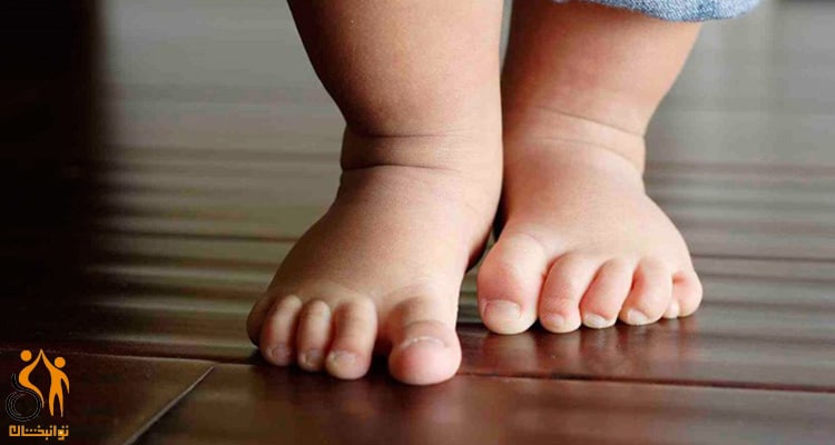 روش‌های درمان صافی کف پا در کودکان